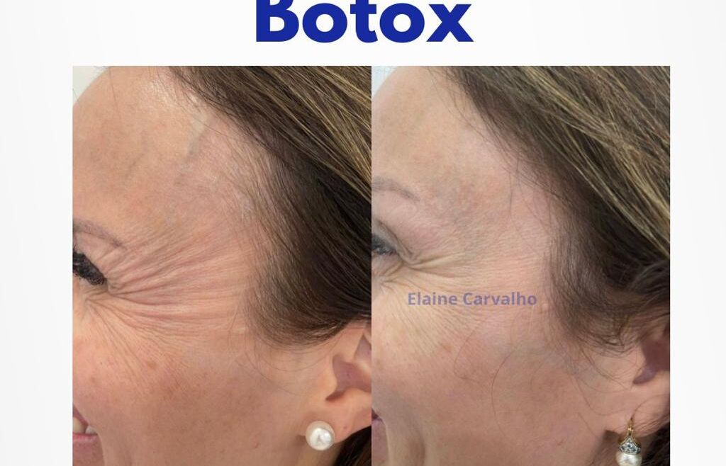 Botox, Resultados Naturais e Rejuvenescimento Facial em Campinas