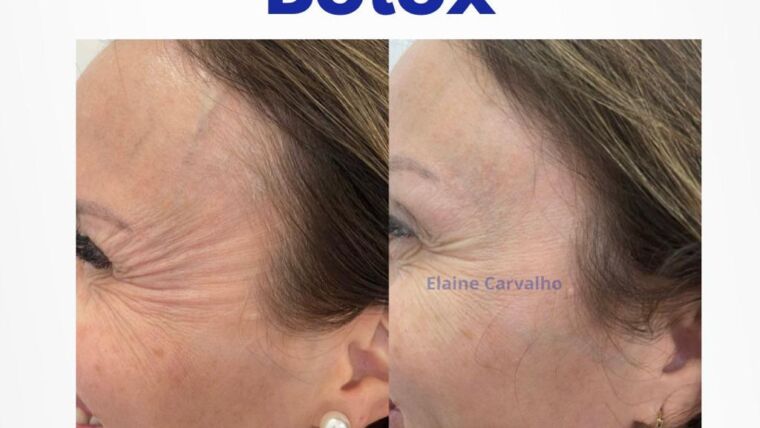 Botox, Resultados Naturais e Rejuvenescimento Facial em Campinas
