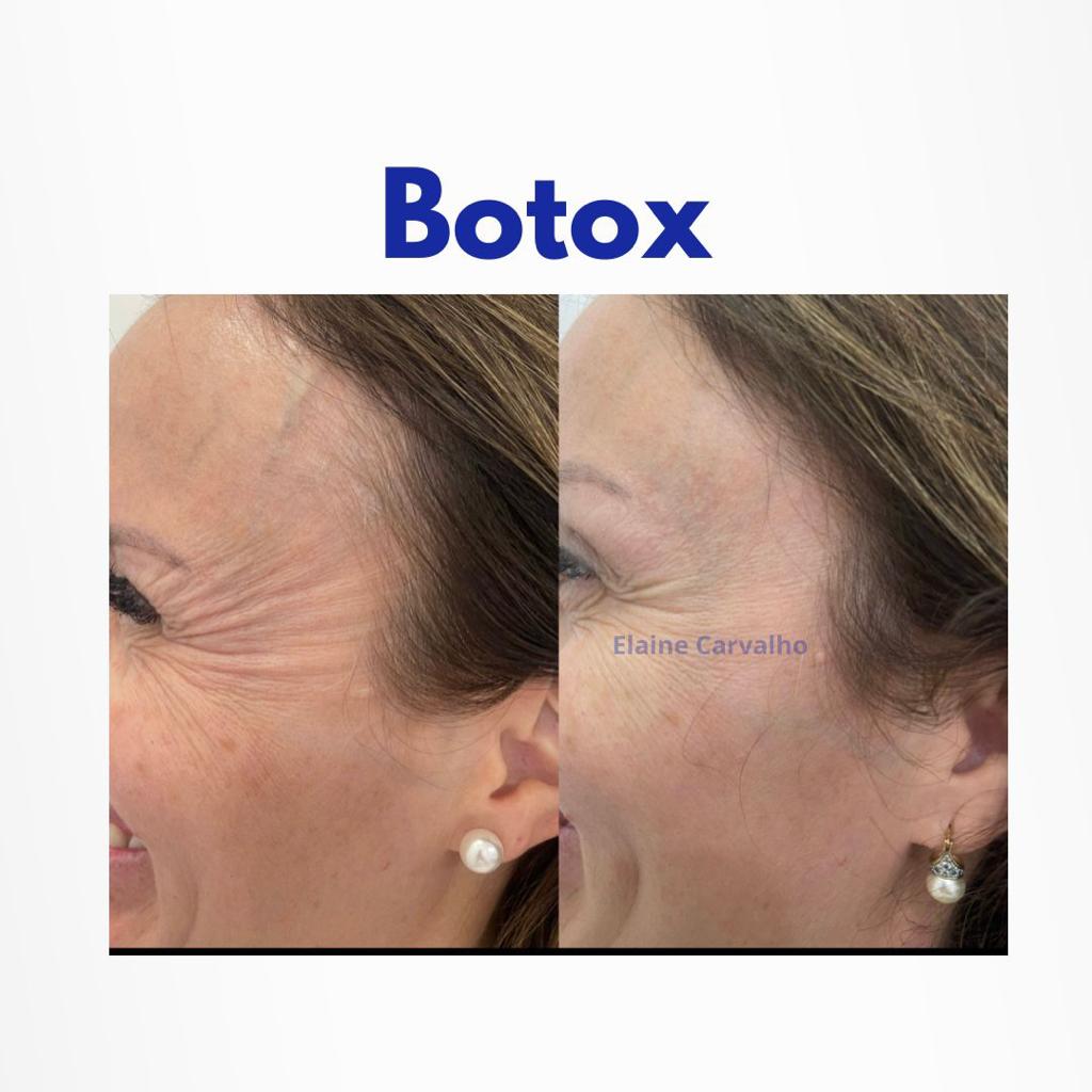 Botox, Resultados Naturais e Rejuvenescimento Facial em Campinas