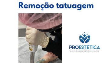 Curso Laser Remoção Tatuagem
