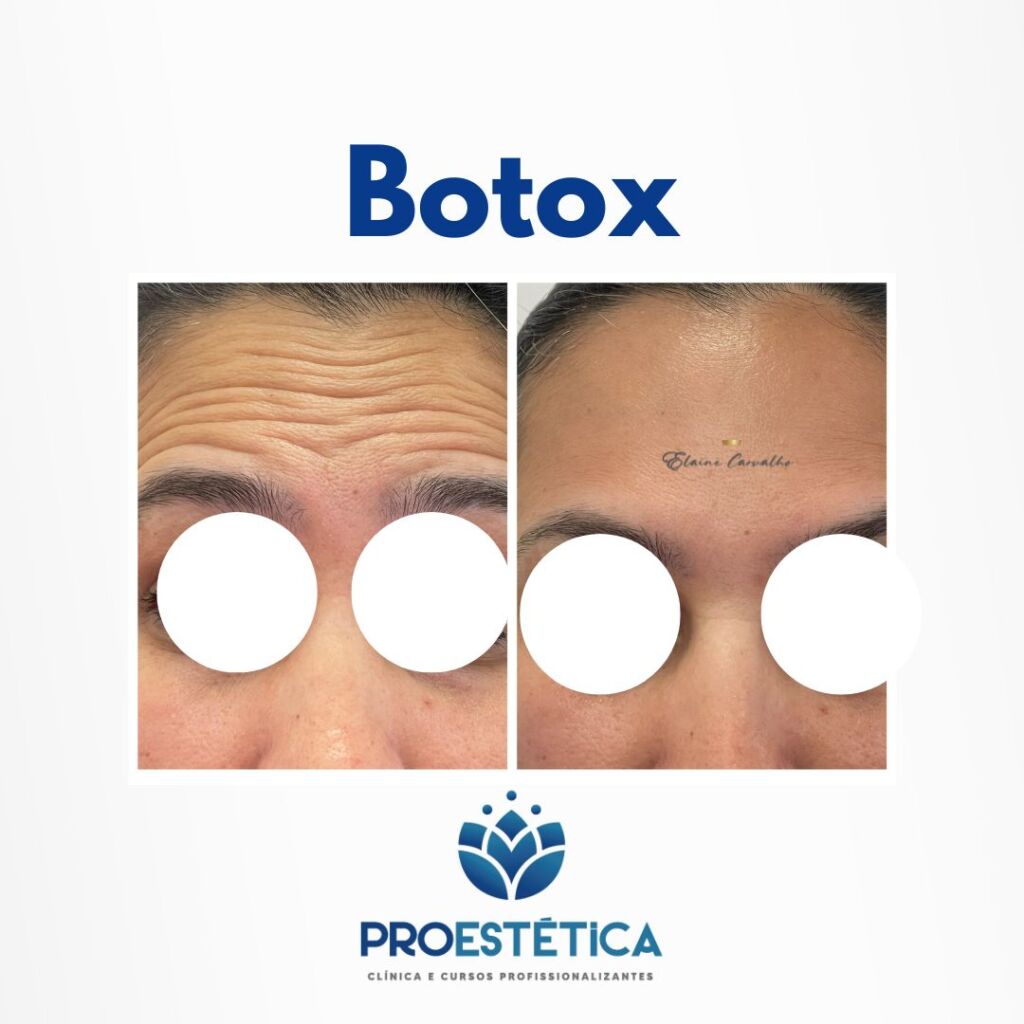 antes e depois botox