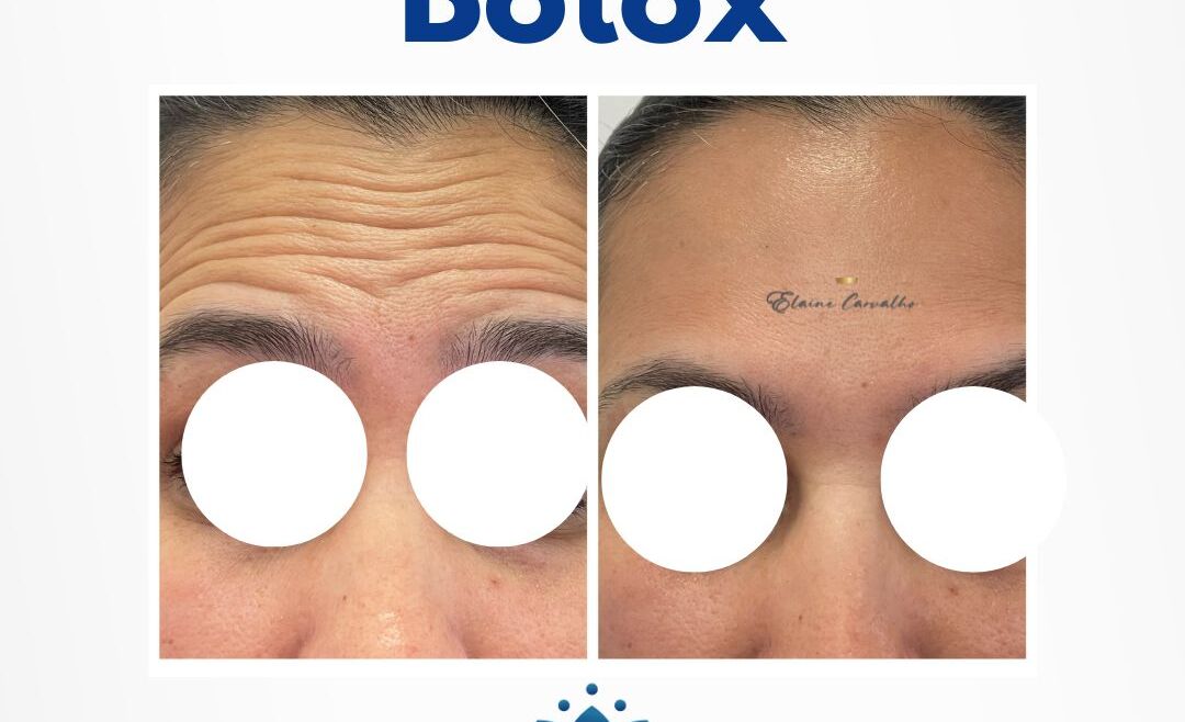 Botox Antes e Depois: O Que Esperar e Como Maximizar os Resultados